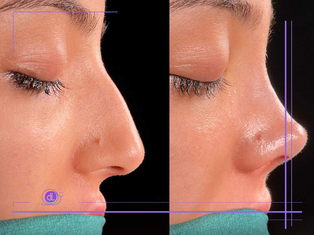 عمل بینی سبک ترکیه‌ای-2