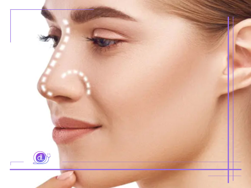عمل پره های بینی-1 عمل پره های بینی-1