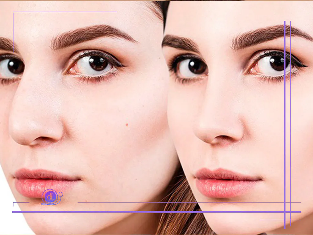 عمل پیزوسرجری در شیراز | مزایا، هزینه و مراحل انجام عمل پیزو سرجری در شیرلز-1