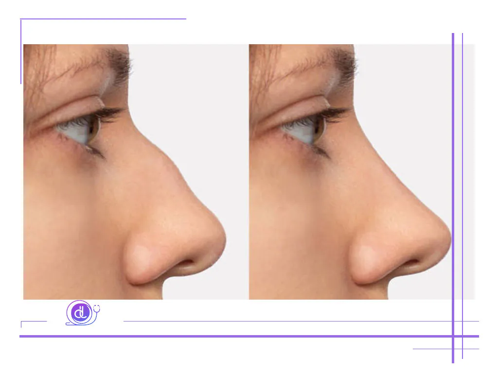 بهترین جراح بینی طبیعی در تهران | معرفی 5 پزشک برتر + هزینه و نمونهکار بهترین جراح بینی طبیعی در تهران-1