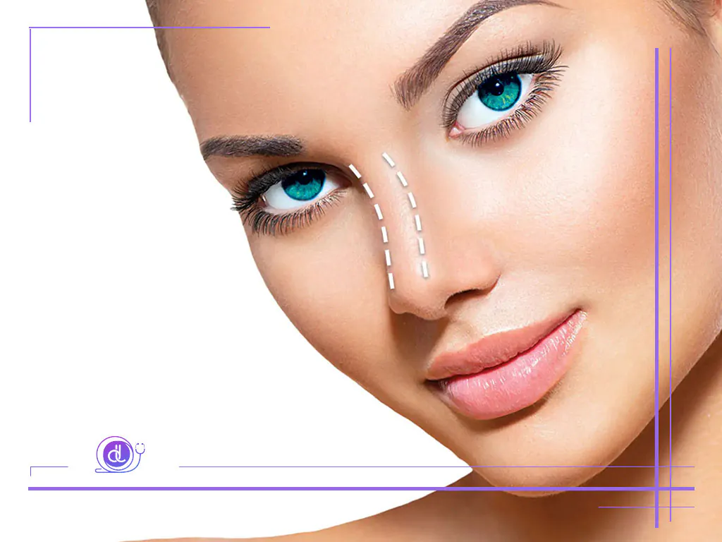 جراحی بینی به روش پرزرویشن در شیراز؛ تکنیکی نو برای نتایجی طبیعی و بدون زخم خارجی جراحی بینی به روش پرزرویشن در شیراز-2