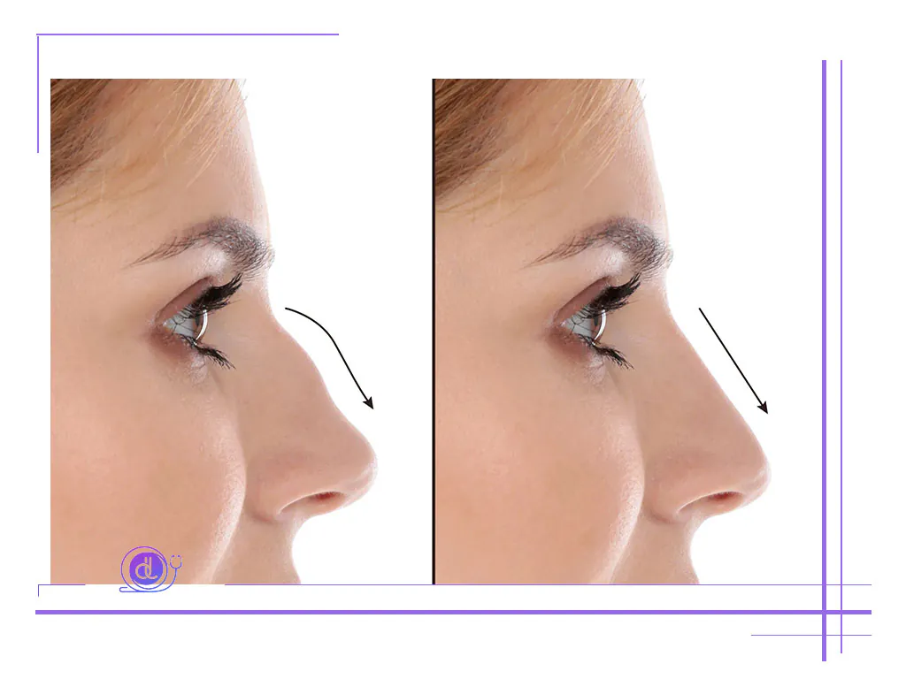 هزینه عمل بینی استخوانی در تهران (۱۴۰۴) هزینه بینی استخوانی در تهران-5