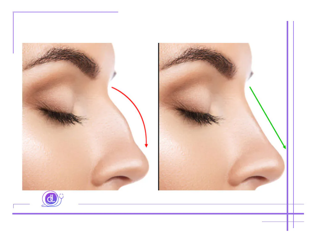 هزینه عمل بینی استخوانی در تهران (۱۴۰۴) هزینه عمل بینی استخوانی در تهران-1