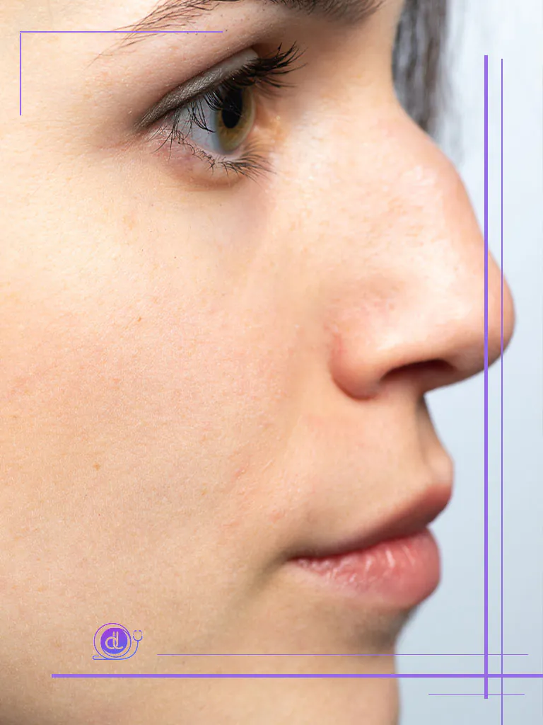 هزینه عمل بینی استخوانی در تهران (۱۴۰۴) هزینه عمل بینی استخوانی در تهران-2