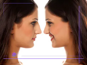 هزینه عمل بینی استخوانی در تهران