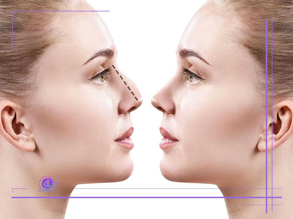 هزینه عمل بینی در تهران-5