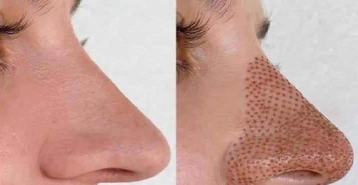 چربی سوزی بینی گوشتی-2 چربی سوزی بینی گوشتی-2