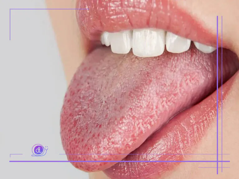 خشکی دهان بعد از عمل بینی