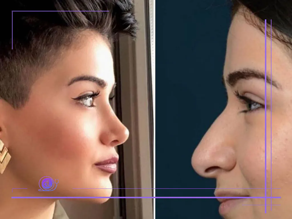 هزینه بینی فانتزی در تهران-3