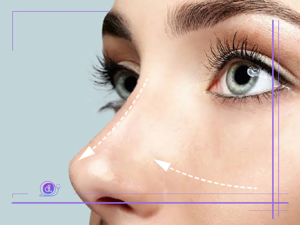 هزینه بینی فانتزی در تهران-5