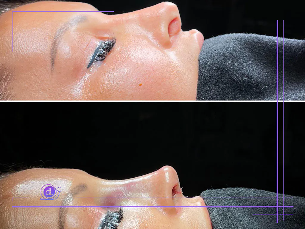 هزینه بینی فانتزی در تهران-6