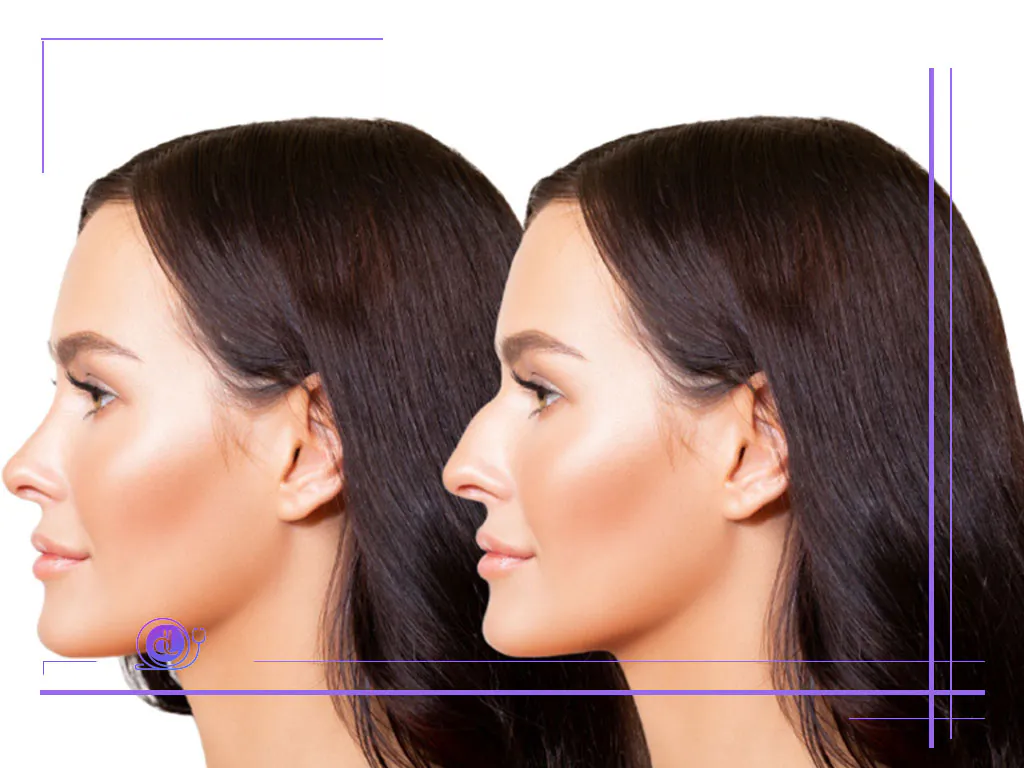 هزینه عمل بینی استخوانی در شیراز-2