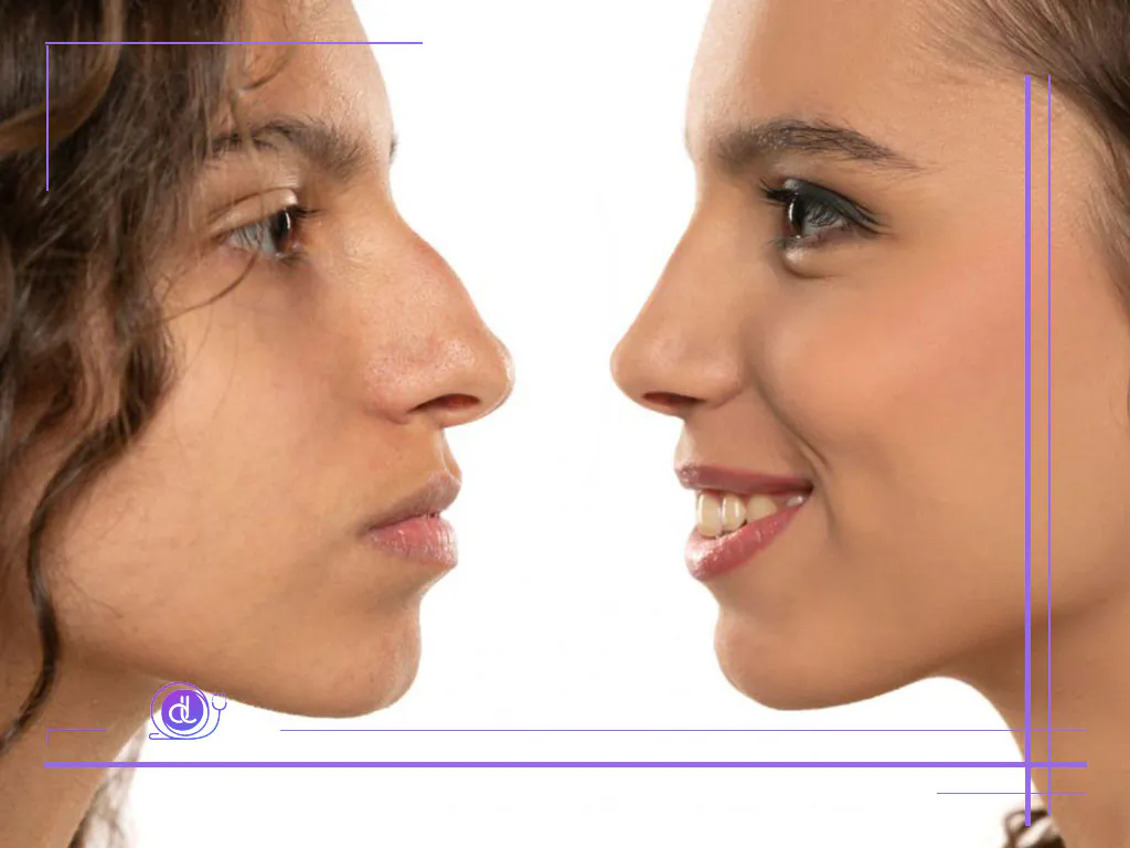 هزینه عمل بینی استخوانی در شیراز-3