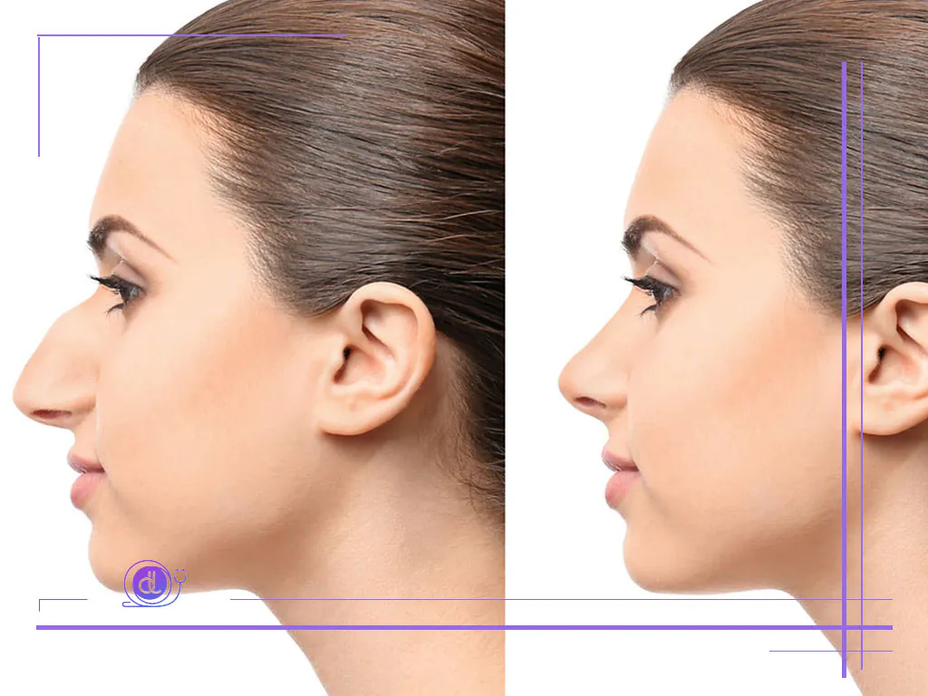 هزینه عمل بینی استخوانی در شیراز-4